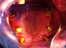 Protesi Fissa Metallo Ceramica con Passivazioni in Galvano