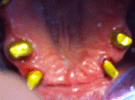 Protesi Fissa Metallo Ceramica con Passivazioni in Galvano