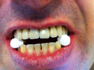 Protesi Fissa Metallo Ceramica con Passivazioni in Galvano