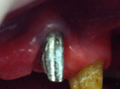Protesi Fissa Metallo Ceramica con Passivazioni in Galvano