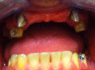 Protesi Fissa Metallo Ceramica con Passivazioni in Galvano
