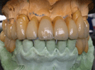 Protesi Fissa Metallo Ceramica con Passivazioni in Galvano