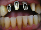 Protesi Dentali Fisse su Impianti