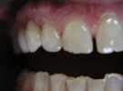 Protesi Metal Free Zirconio Ceramica