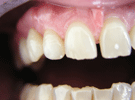 Protesi Metal Free Zirconio Ceramica
