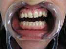 Protesi Metal Free Zirconio Ceramica